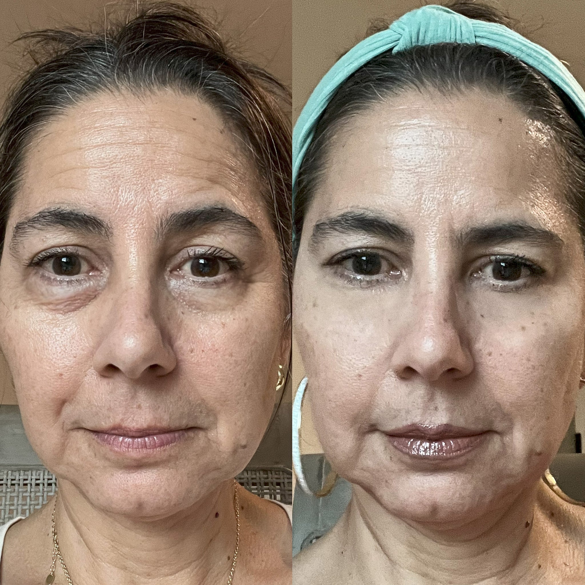 RevitalEyes | Roodlichttherapie Voor Onder De Ogen