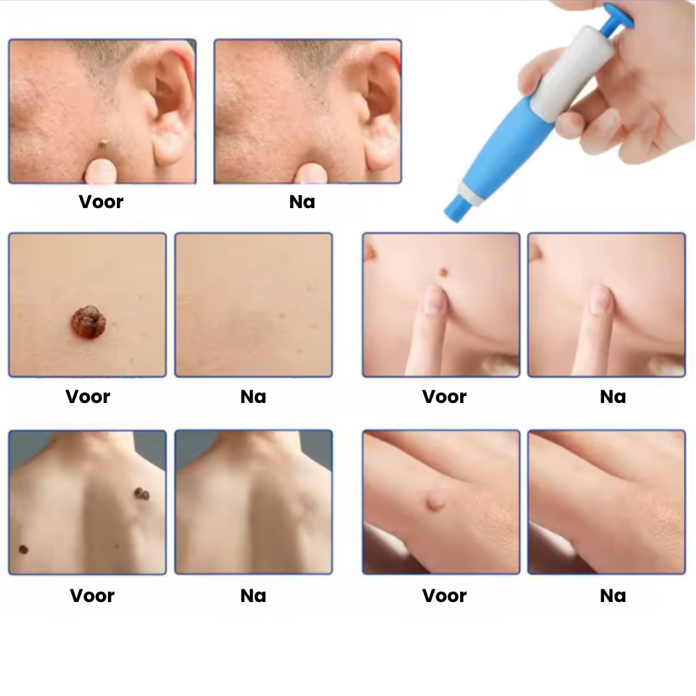 TagPen Kit | Verwijder steelwratjes gemakkelijk vanuit huis