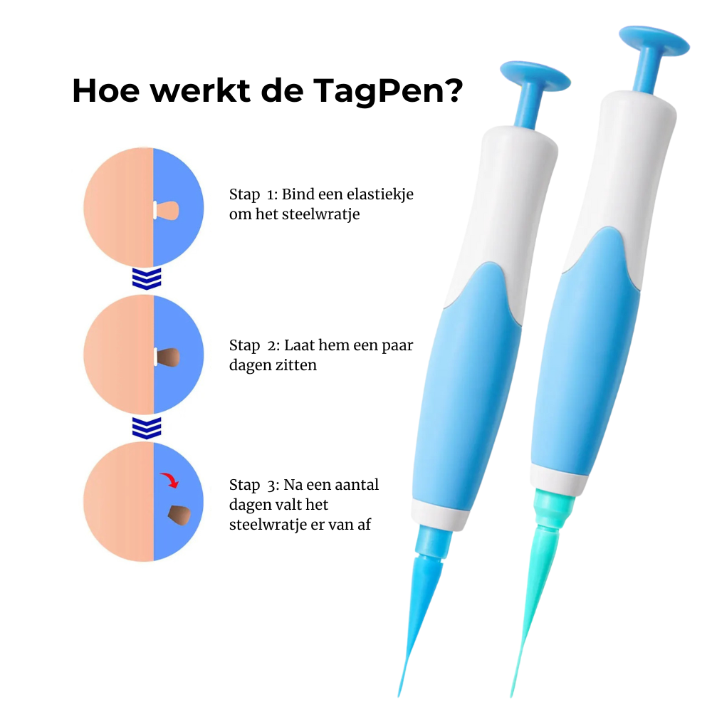 TagPen Kit | Verwijder steelwratjes gemakkelijk vanuit huis