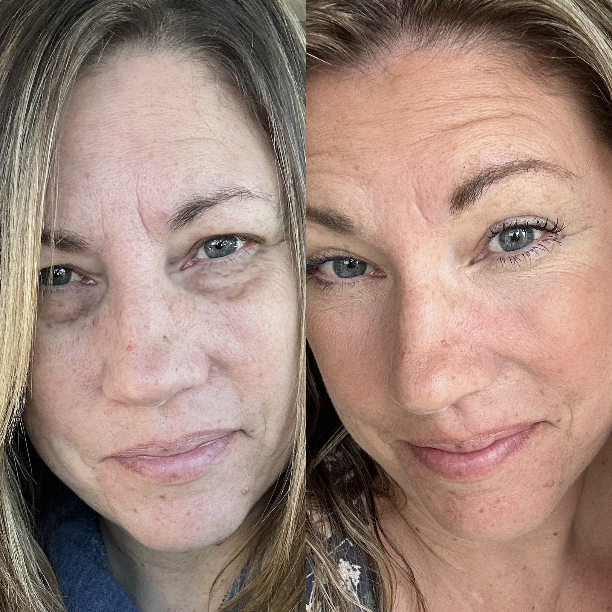 RevitalEyes | Roodlichttherapie Voor Onder De Ogen