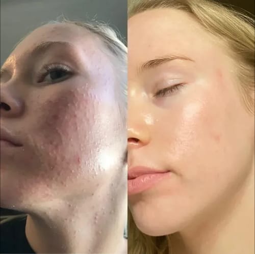 LUMITY | Hoogfrequente Gloeiapparaat