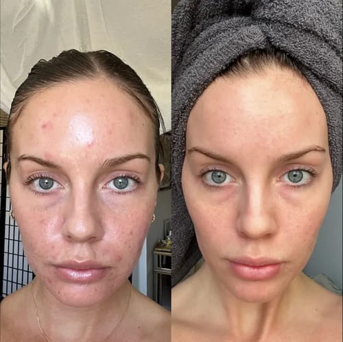 LUMITY | Hoogfrequente Gloeiapparaat